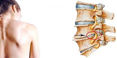 A méhnyak osteokondrózis fejlődésének mechanizmusa
