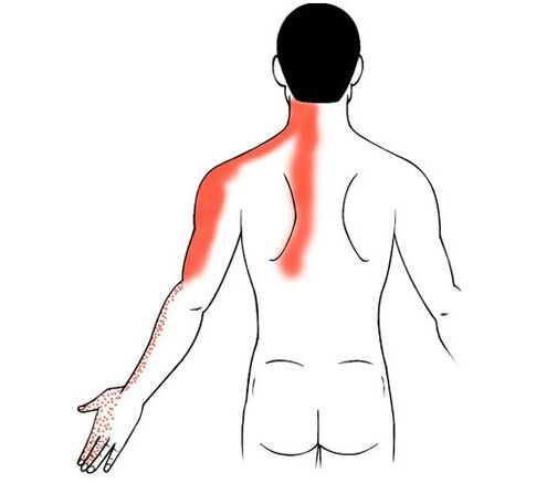 nyaki osteochondrosis, mint az ujjak ízületi fájdalmának oka