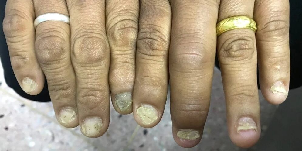 Az ujjak duzzanata és a körömlemez deformációja a pszoriázisos ízületi gyulladás kialakulását jelezheti