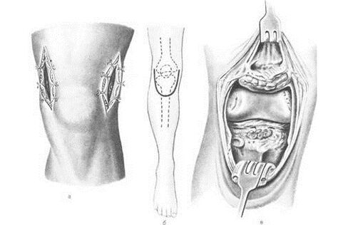 arthrotómiás műtét arthrosis esetén